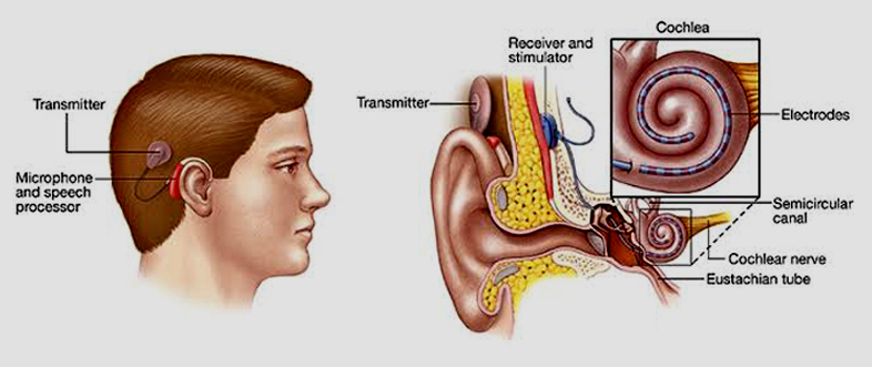 Cochlear implants Explanation Image